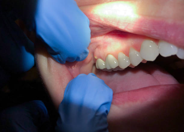 Best Knocked-Out Tooth (Avulsed Tooth) Treatment in Kittitas, WA